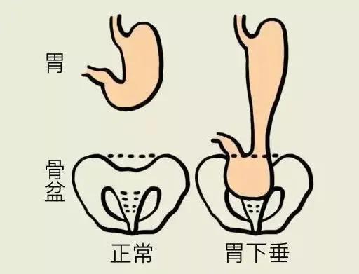 小伙与人拼酒,12瓶下肚狂喊"救命",到医院崩溃:胃下垂到盆腔(2)