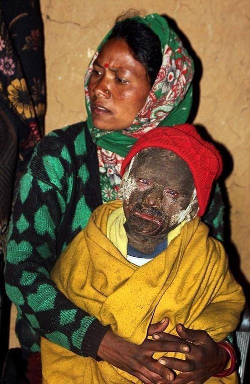 全世界不到10例11岁男孩患罕见怪病没钱医治将变石头人