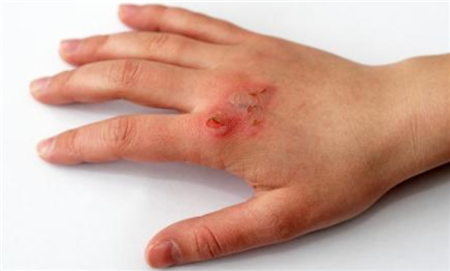 男子不幸得了罕见病他的身体会自行燃烧双眼也要缝合起来3