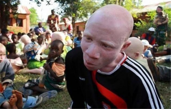 非洲一群特殊人，因皮肤变白被当成药材，警察24小时贴身保护