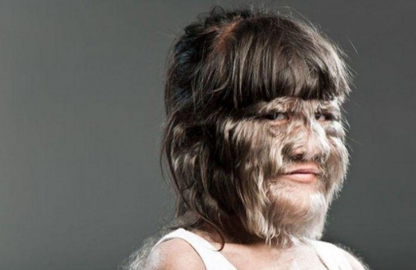 喝67生发水治胃病西班牙20名儿童全身长满毛患罕见狼人症