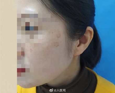 90后女孩熬夜10年长出老年斑：没在2点前睡过
