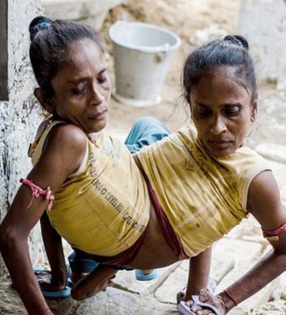 印度连体姐妹同嫁一夫三人的婚后生活太尴尬镜头记录全过程