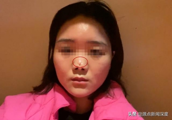 四川一女子上海取肋骨做隆鼻手术自称遭毁容，查出重度抑郁，司法鉴定显示医方最高担责8.5成，她获赔7万余元
