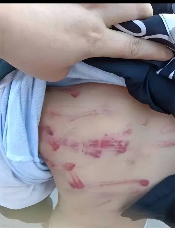 因做错数学题三年级小学生被老师打得遍体鳞伤警方介入