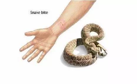 女子被蛇咬后模仿影视剧用嘴吸毒,伤反而加重,医生紧急提醒!