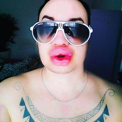 32岁男子花巨资整容20多次,结果整容成香肠嘴_看看头条_中华网