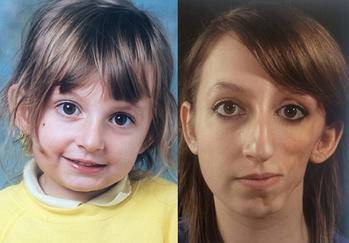 女孩患罕见病一半的脸萎缩全世界不到1000例